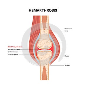 Hemarthrosis in the synovial joint