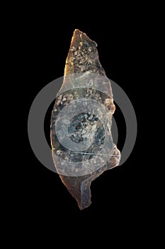 Hematogenic tuberculosis