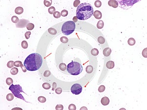 Hematogones in bone marrow.