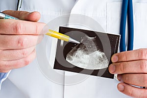 Hematoma of spleen on ultrasound image concept photo. Doctor indicating by pen on printed picture ultrasound pathology -  splenic