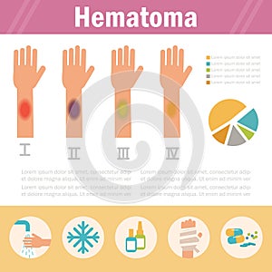 Hematoma. Stages. Isolated photo