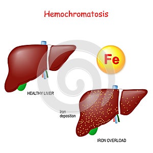 Hemochromatosis or Iron overload. Healthy liver and liver with  iron deposits