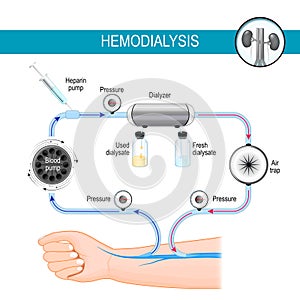 Hemodialysis machine. Dialysis process photo