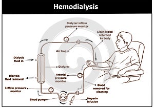 Hemodialysis procedure. Used for the renal insufficiency.