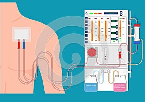 Hemodialysis is a process of filtering the blood of a person photo