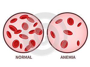 Hemoglobin. Anemia symptoms, blood disease. Health care concept.