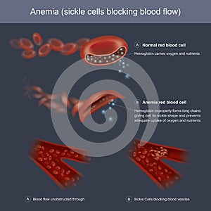 Hemoglobins improperly forms long chains giving cell its sickle