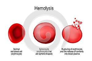 Hemolysis. Normal red blood cell, spherocyte, and rupturing of e photo