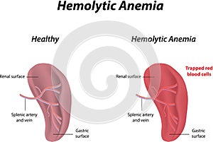 Hemolytic Anemia photo