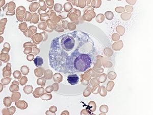Hemophagocytosis photo