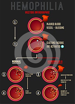 Hemophilia Blood Clotting Process photo