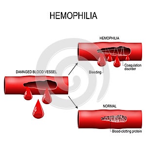 Hemophilia is Coagulation disorder