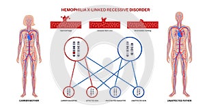 Hemophilia inheritance poster photo