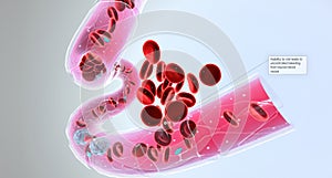 Hemophilia is a recessive genetic disorder that impairs the ability of blood to clot