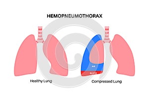 Hemopneumothorax medical poster