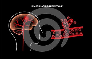 Brain stroke hemorrhagic photo