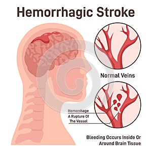 Hemorrhagic brain stroke concept. Hemorrhage in the brain, rupture