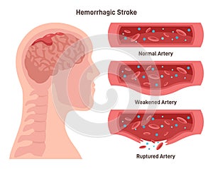 Hemorrhagic brain stroke. Damaged human brain,weakend and ruptured