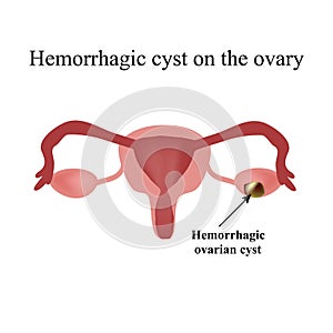 Hemorrhagic cyst on the ovary. Ovary.