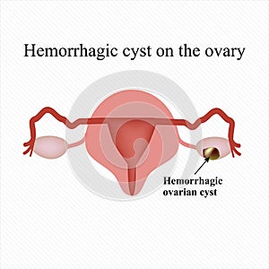Hemorrhagic cyst on the ovary. Ovary. Infographics. illustration photo