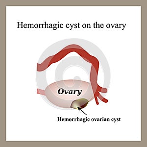 Hemorrhagic cyst on the ovary. Ovary. Infographics. photo
