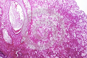 Hemorrhagic infarct of the lung