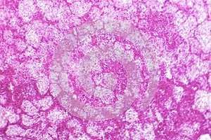 Hemorrhagic infarct of the lung