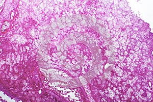 Hemorrhagic infarct of the lung