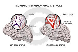 Hemorrhagic and ischemic stroke photo