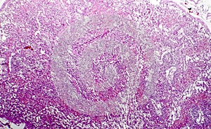 Hemorrhagic lymphadenitits, lymph node inflammation and hemorrhage