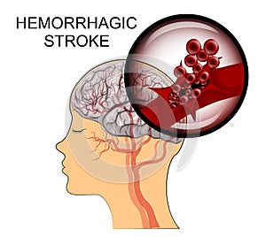 Hemorrhagic stroke