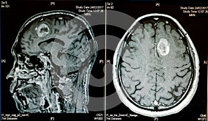 Hemorrhagic stroke