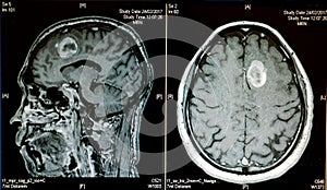 Hemorrhagic stroke photo