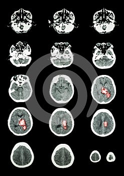 Hemorrhagic Stroke . CT scan (computed tomography) of brain ( c