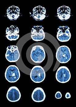 Hemorrhagic Stroke . CT scan (computed tomography) of brain ( c photo