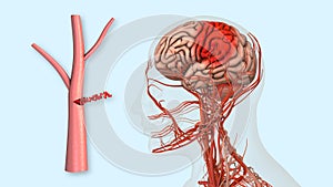 Hemorrhagic stroke effects on the brain