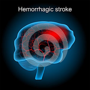 Hemorrhagic stroke. human brain with blood vessels and hematoma