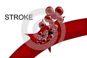 Hemorrhagic stroke. insult. rupture of the vessel photo