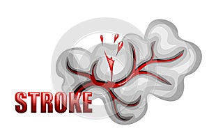 Hemorrhagic stroke. insult. rupture of the vessel