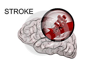 Hemorrhagic stroke. insult. rupture of the vessel photo