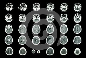 Hemorrhagic Stroke and Ischemic Stroke