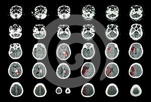 Hemorrhagic Stroke and Ischemic Stroke . CT scan of brain : intracerebral hemorrhage ( 3 left column , cerebral infarction ( 3 ri