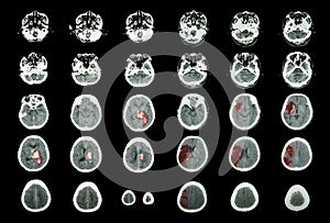 Hemorrhagic Stroke and Ischemic Stroke . CT scan of brain : intracerebral hemorrhage ( 3 left column , cerebral infarction ( 3 ri photo