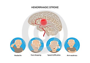 Hemorrhagic stroke and warning signs and symptoms.