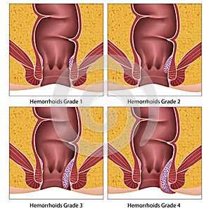 Hemorrhoids grade anatomy education info graphic on white background photo