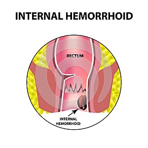 Hemorrhoids internal. Rectum structure. Intestines. colon. Internal hemorrhoidal node. Infographics. Vector illustration