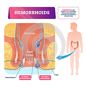 Hemorrhoids vector illustration. Labeled anatomical vascular piles scheme. photo