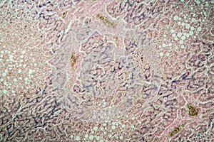 Hemosiderosis liver under a microscope
