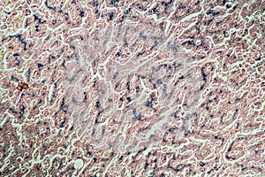 Hemosiderosis liver under a microscope