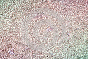 Hemosiderosis tissue